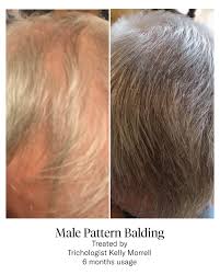 Calecim Advanced Hair Treatment